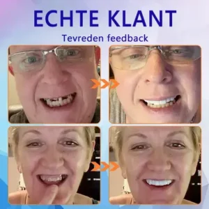 HEATWOLF® 💎Premium Geavanceerd Op Maat Gemaakt Volledig Kunstgebit Set💎 (⏰Tijdelijke korting, nog 30 minuten!)