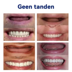 HEATWOLF® 💎Premium Geavanceerd Op Maat Gemaakt Volledig Kunstgebit Set💎 (⏰Tijdelijke korting, nog 30 minuten!)