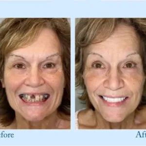 TrueEase™ Custom-Fit Functional Dentures — Perfectly Fitted in Minutes at Home