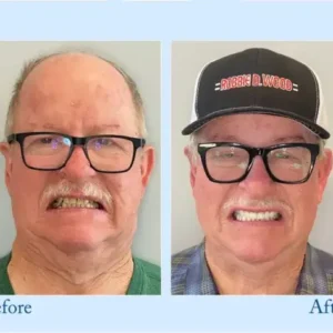 TrueEase™ Custom-Fit Functional Dentures — Perfectly Fitted in Minutes at Home